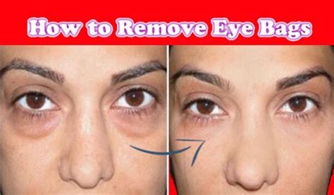 Eye Bags Causes: How to Remove Eye Bags Permanently: Have you ever thought what the best part of ...