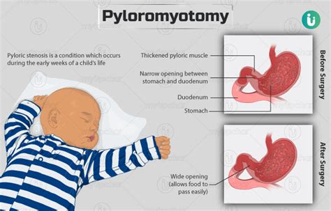 Pyloromyotomy: Procedure, Purpose, Results, Cost, Price