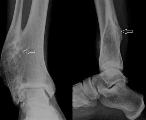 Distal Tibiofibular Joint