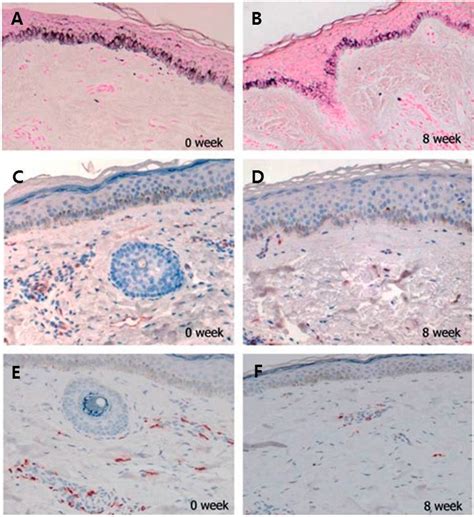 Melasma Histology