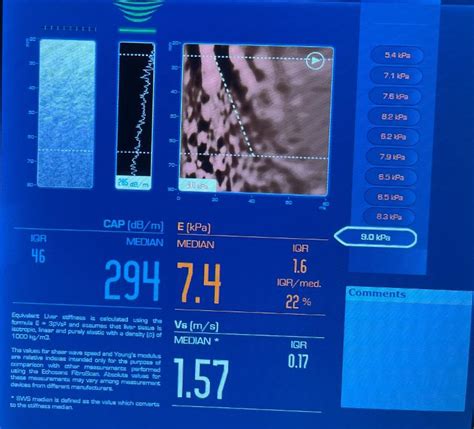 Fibroscan results-help: Here is result... - Living with Fatty...