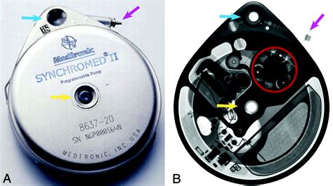 intrathecal baclofen pump | The Tawny's Blog