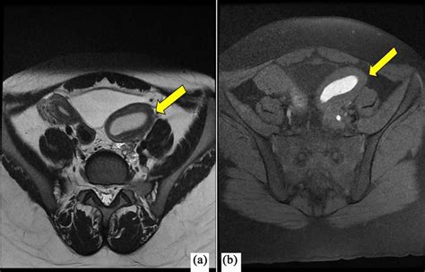 MRI of the pelvis (a) Axial T2WI demonstrating uterus didelphys with... | Download Scientific ...