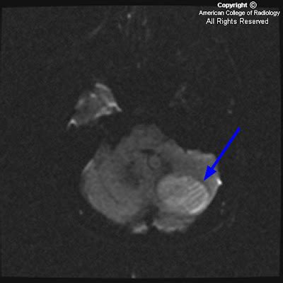 Neuroradiology On the Net: Lhermitte-Duclos disease (LDD)