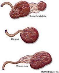 Image result for velamentous insertion ultrasound Nursing Crib, Ob Nursing, Nursing Notes ...