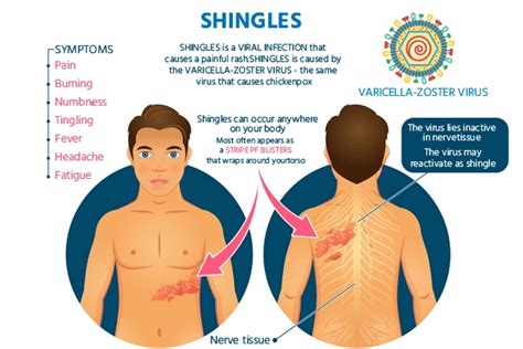 Shingles Symptoms