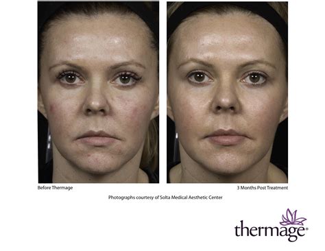 Thermage NYC, Info About Thermage Procedures & Cost - Dr. Michele Green