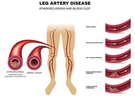 What Causes Vascular Disease in the Legs? | Miami Vein Center