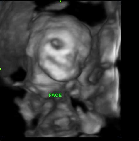 BANGALORE ULTRASOUND BLOG: 3D/4D scan for pregnancy