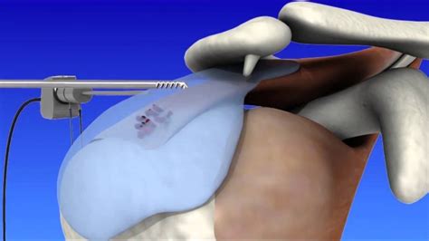 Shoulder Arthroscopy - YouTube