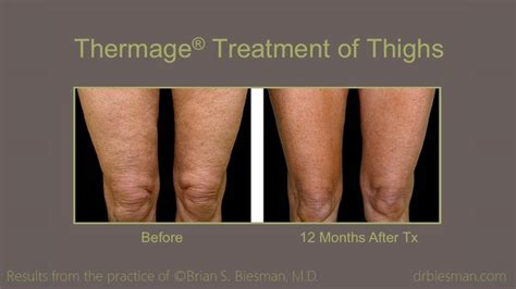 Thermage Before and After Gallery - Brian Biesman MD | Nashville, TN