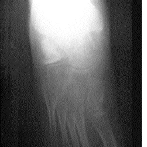 (PDF) [The results of calcaneal lengthening osteotomy for the treatment of flexible pes ...