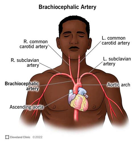 What Is the Brachiocephalic Artery?