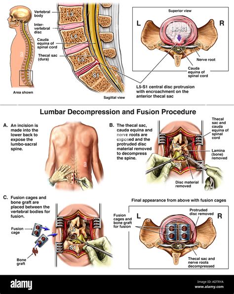 Lumbar Spine Injury - L5-S1 Disc Herniation with Posterior Spinal Stock Photo, Royalty Free ...