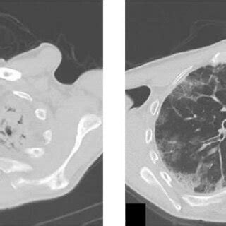 (PDF) Pleuroparenchymal Fibroelastosis following Asbestos Exposure