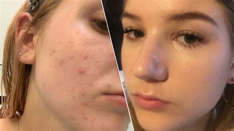 Accutane Side Effects: 9 Things to Know About the Acne Treatment | Glamour