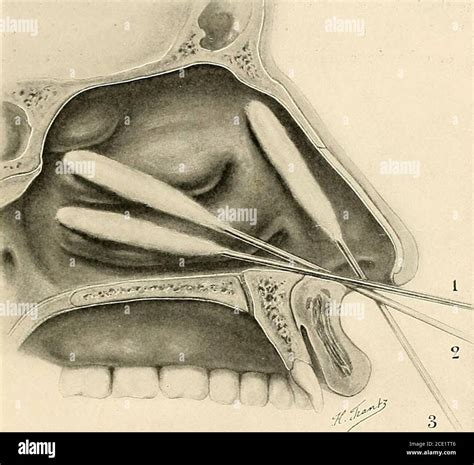 Medial nerve block hi-res stock photography and images - Alamy