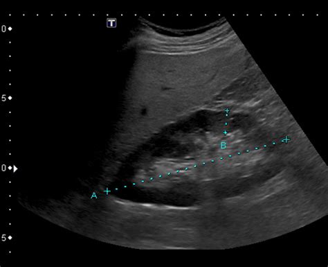 Renal Artery Stenosis | Cedars-Sinai