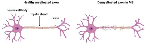 Multiple Sclerosis Neuron