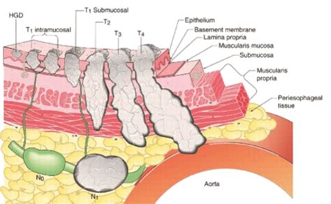 TN Staging of Esophageal Cancer. © Copyright 2001-2015. 1800 Orleans ...