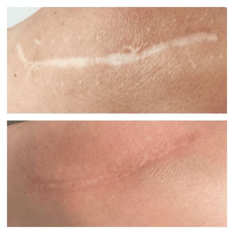 Scar Removal Laser Treatment - Nikki Butler: Skin Specialist in Hampshire.