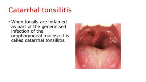 Tonsillitis, quinsy and adenoiditis