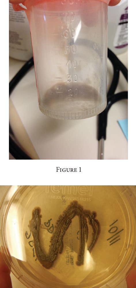 Figure 1 from Exophiala Pneumonia Presenting with a Cough Productive of ...