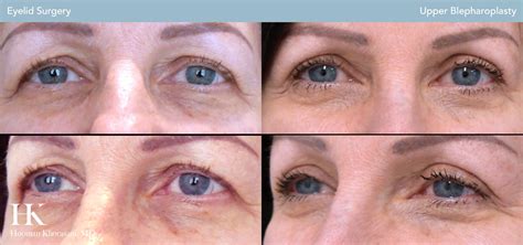 9 Tips to Speed Recovery After Eyelid Surgery (Blepharoplasty)