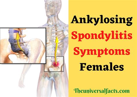 Ankylosing Spondylitis Symptoms Females, The spine is the part of the skelet… | Ankylosing ...