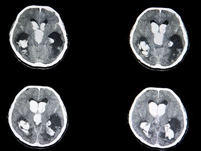 Traumatic Brain Injuries — What Medical Imaging Reveals | Touchstone Imaging