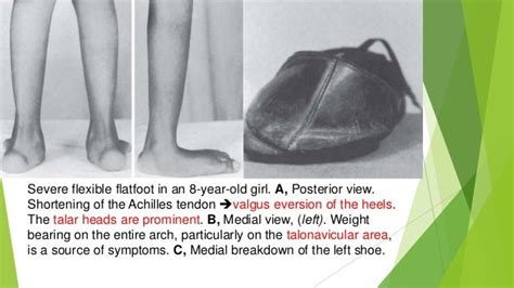 Flexible flatfoot (pes planovalgus)