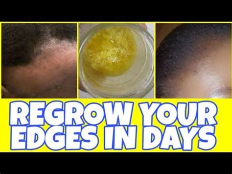 Use THESE Ingredients To Regrow Bald Edges and Your Natural Hair Fast : DIY Ginger hair oil