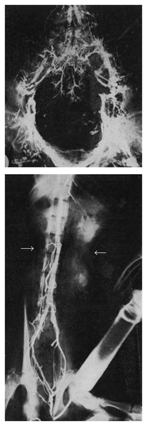 Batson venous plexus, from Batson O.V., “The function of the vertebral ...