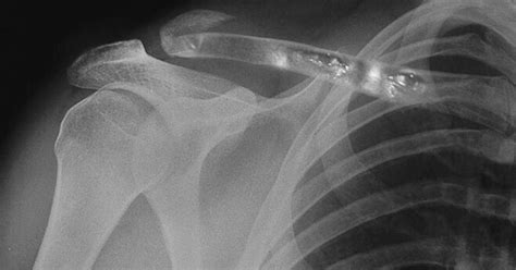 X-Ray Of Packers QB Aaron Rodgers' Broken Collarbone Released (PIC)