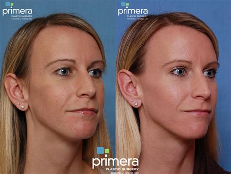 Dermabrasion Before and After Pictures Case 79 | Orlando, Florida | Primera Plastic Surgery