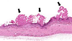 IPLab:Lab 3:Fibrinous Pericarditis - Pathology Education Instructional ...