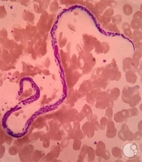 THE NIGHT TRAVELLER– MICROFILARIA IN PERIPHERAL BLOOD SMEAR