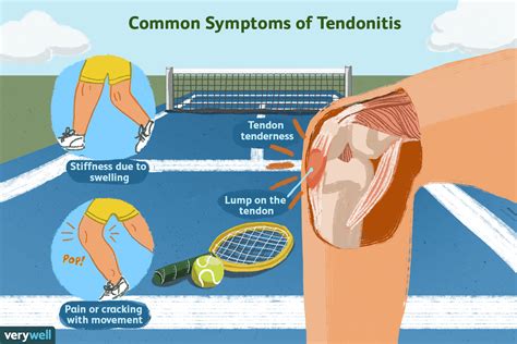 Tendonitis คืออะไร? - MedThai