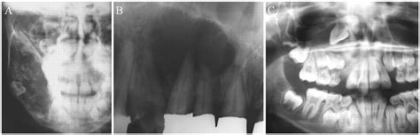 Radiographic Findings of Odontogenic Myxomas on Conventional Radiographs | Anticancer Research