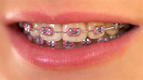 Pink braces – SmileCentre