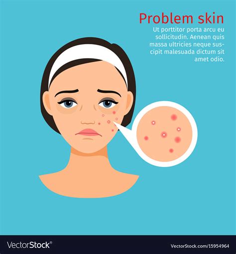 Woman face problem skin with acne Royalty Free Vector Image