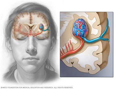 Brain AVM (arteriovenous malformation) Disease Reference Guide - Drugs.com