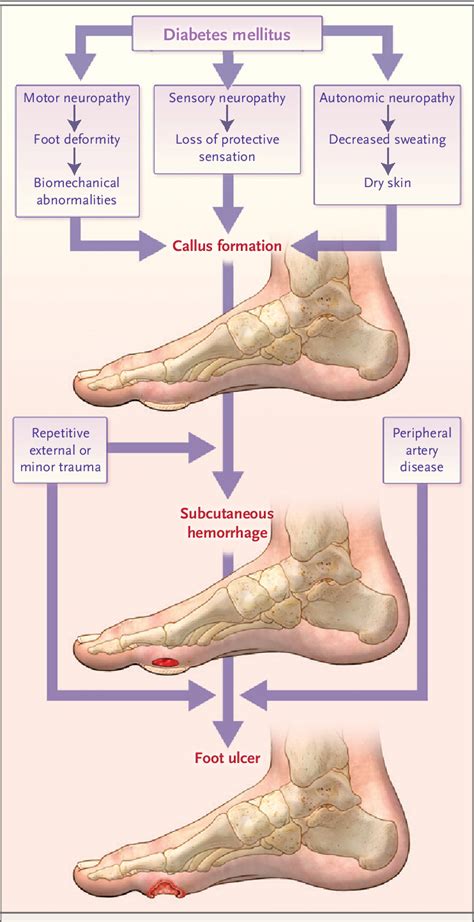 Figure 1 from Diabetic Foot Ulcers and Their Recurrence. | Semantic Scholar