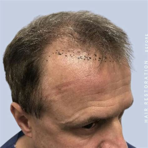 Patient 121378356 | Men's Hair Before & After Photos | Dr. Hardik Doshi