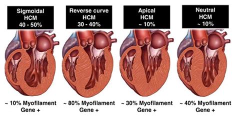 Diagnosis and Management of Hypertrophic Cardiomyopathy - American College of Cardiology