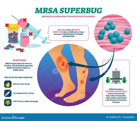 MRSA Methicillin-Resistant Staphylococcus Aureus Infection Royalty-Free Stock Photography ...