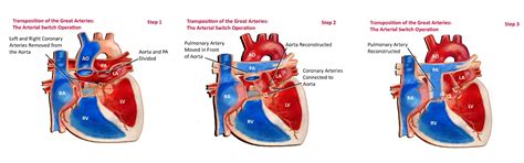 Arterial Switch Operation - Pediatric Cardiology Associates of Houston