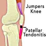 Jumpers Knee (Patellar Tendonitis) - Pro Knee Pain Relief