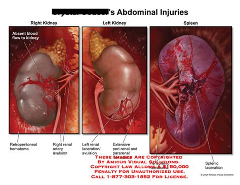 AMICUS Illustration of amicus,injury,abdominal,abdomen,kidney,spleen,hematoma,retroperitoneal ...