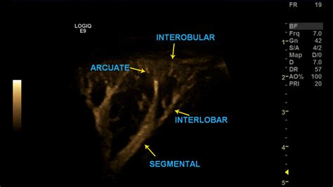 Renal Artery Doppler – Sonographic Tendencies